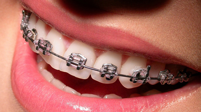 Types Of Braces 